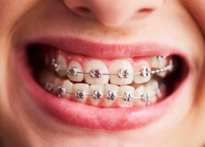 Soft food planning for children dealing with braces pain