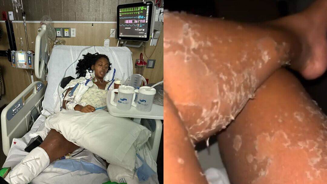 Woman shares how venomous spider bite had all her skin peeled off