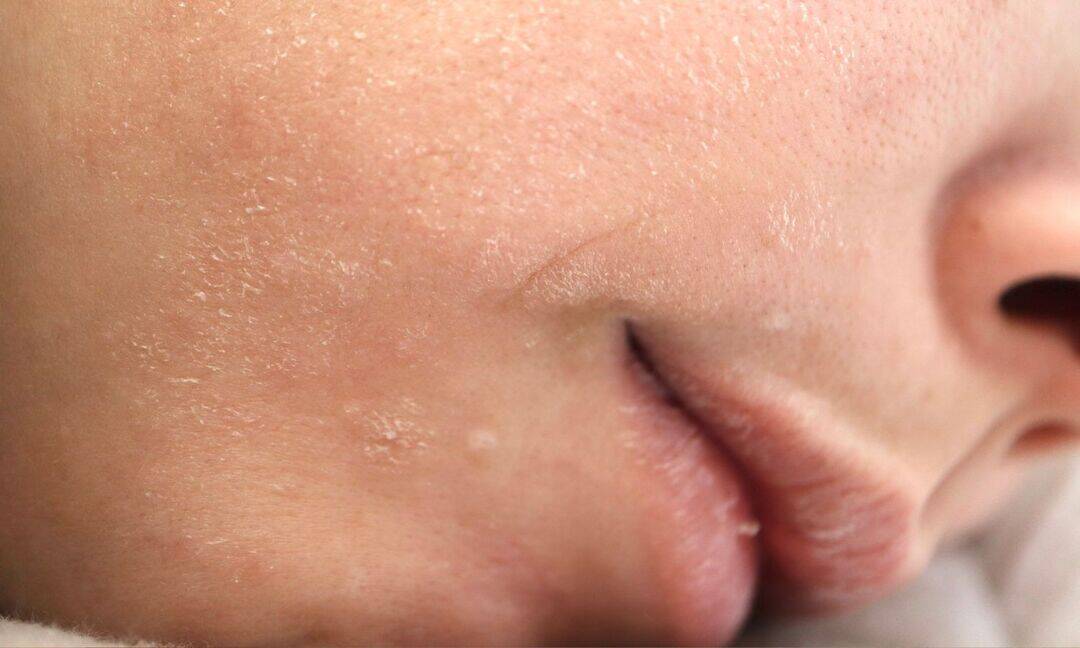 Do frequent colds and dry skin indicate vitamin C deficiency?