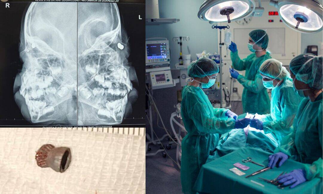 Toddler's air gun pellet eye injury treated successfully