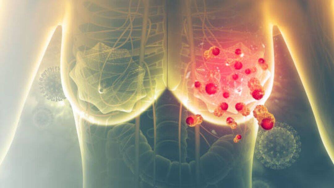 Breast cancer among top three cancers in Indian women: ICMR study