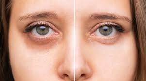 How is the liver linked to dark circles?
