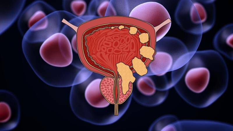 Study finds way to predict bladder cancer recurrence