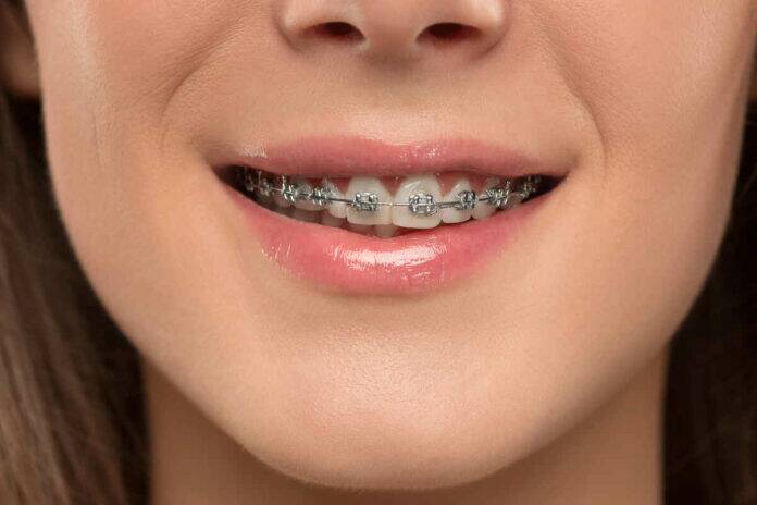 Why fake braces are dangerous for your teeth and health?