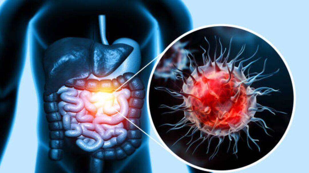 How family history and genes raise risk of colon cancer?