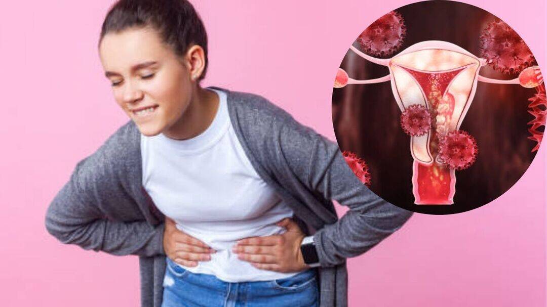 Severe period pain in teens may signal endometriosis