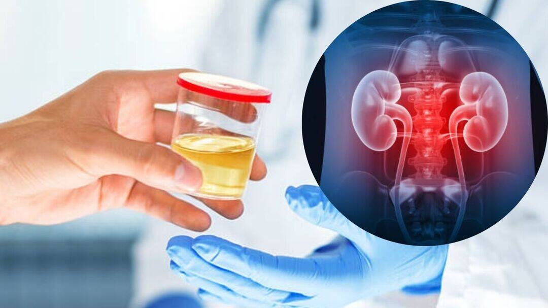 What your urine colour says about kidneys?