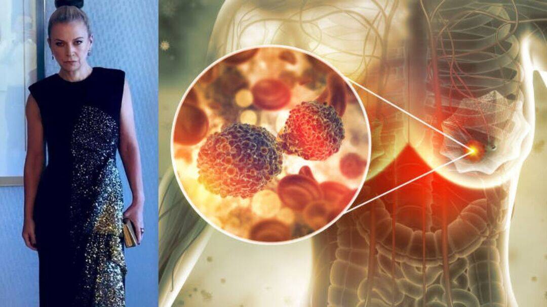 Jane Fallon had no symptoms, routine scan found breast cancer