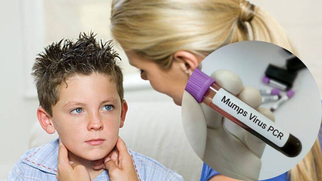 Rising mumps cases across the United States, what you need to know