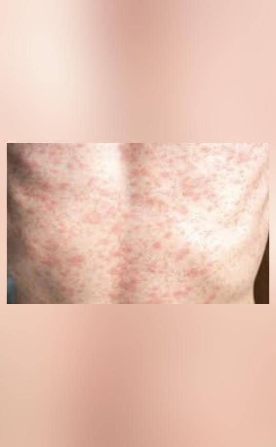 Measles cases rise in Nepal, vaccination drive launched