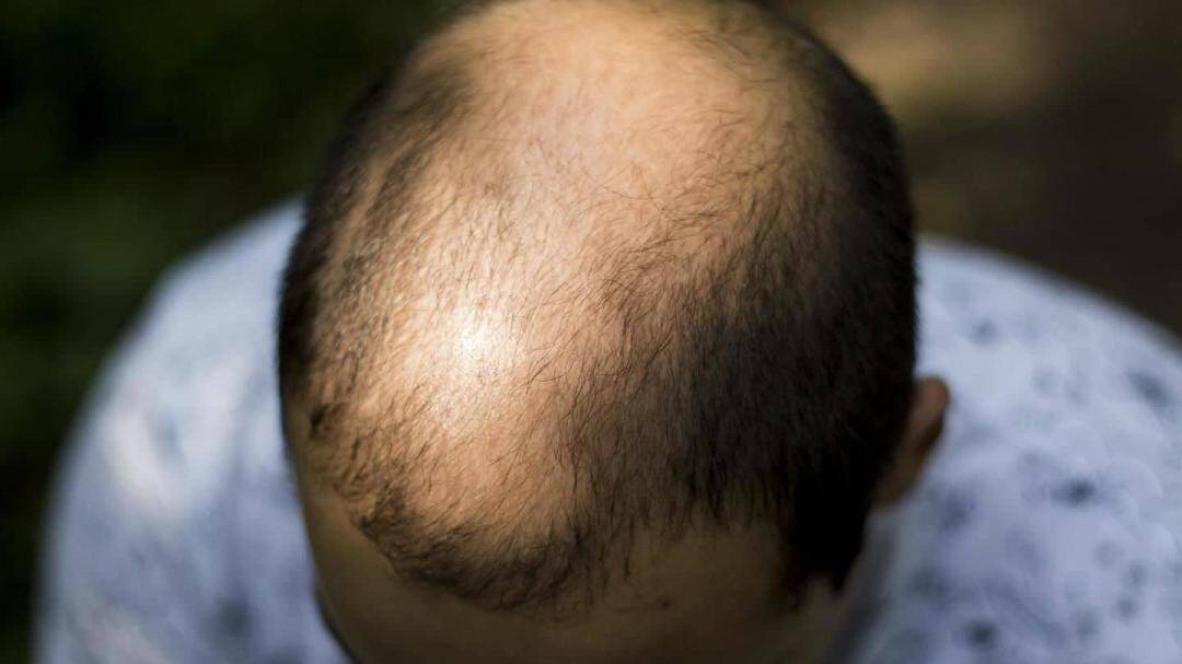 Scientists grow hair follicles in lab that could cure baldness