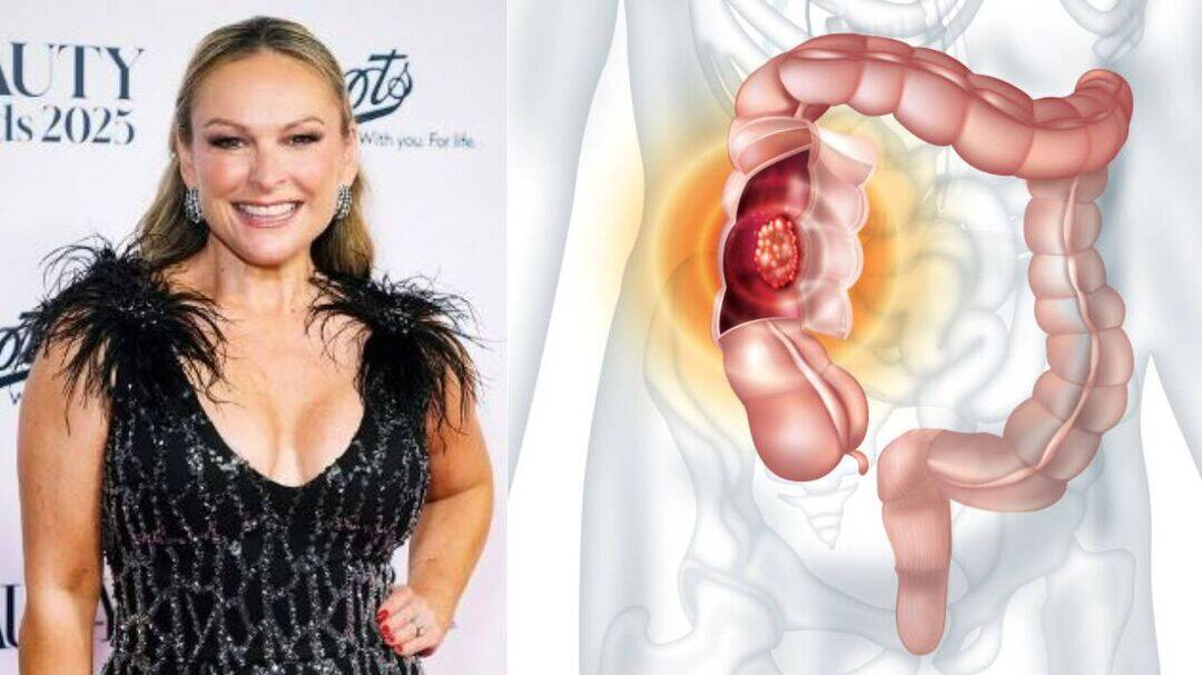 Mel Schilling reveals stage 4 colon cancer that has metastasised