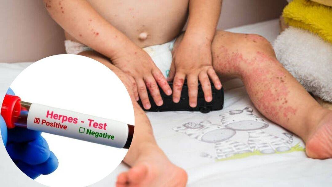 Newborn in Israel contracts herpes after Brit Milah, sparks alarm