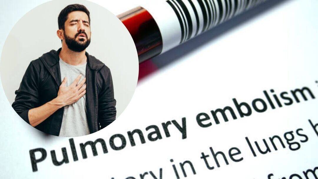 Breathlessness could signal deadly pulmonary embolism, warns AHA