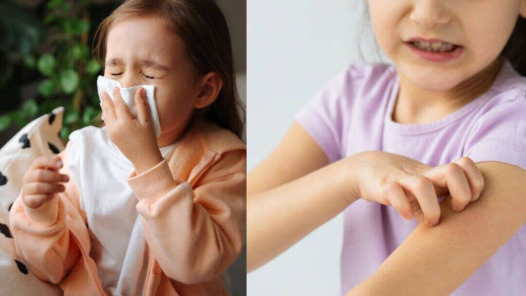 Childhood allergies spike as immunity in kids go down, say doctors