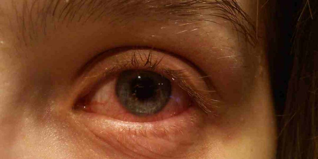 Conjunctivitis rising in TN: Doctors explain dos and don'ts