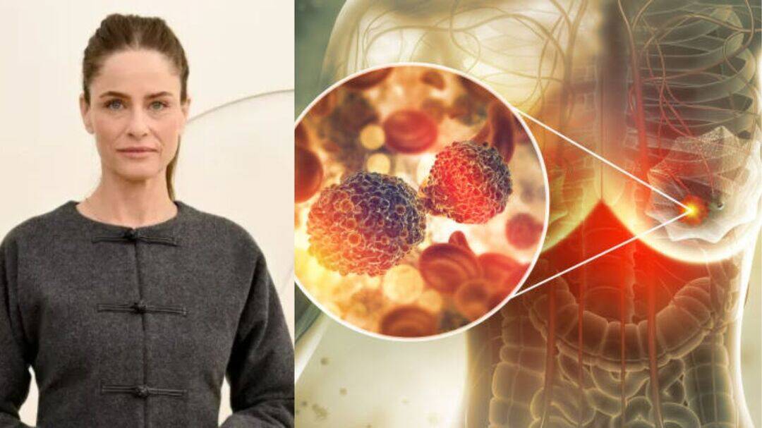 Amanda Peet reveals breast cancer diagnosis, urges early screening