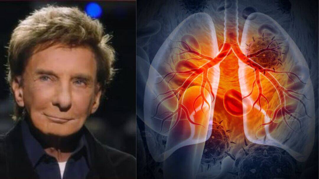 Barry Manilow lung cancer surgery: What a lobectomy means?