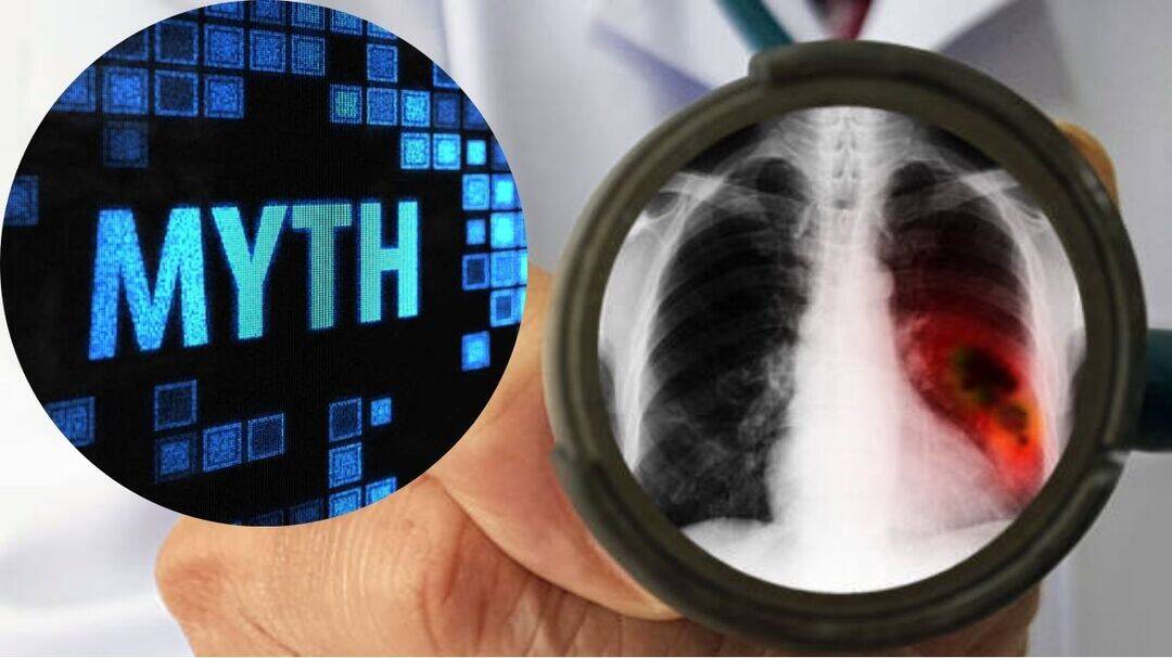 Expert debunks myths and facts of lung cancer