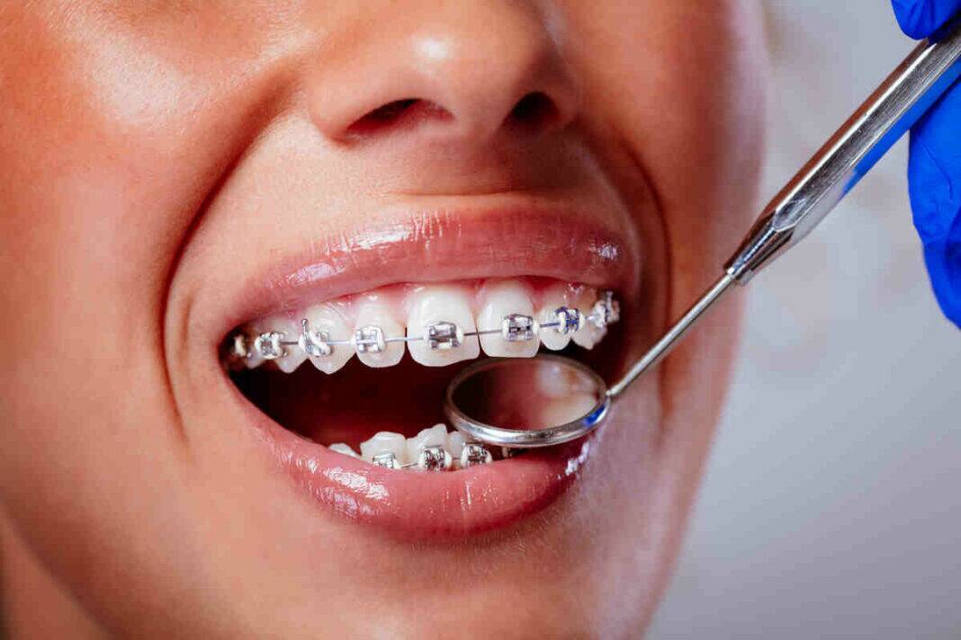 Braces align teeth, don’t significantly change jaw growth: Experts