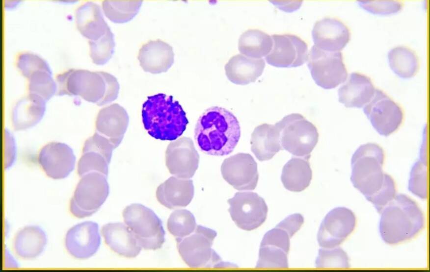 Why is Glioma called silent but deadly brain tumour?