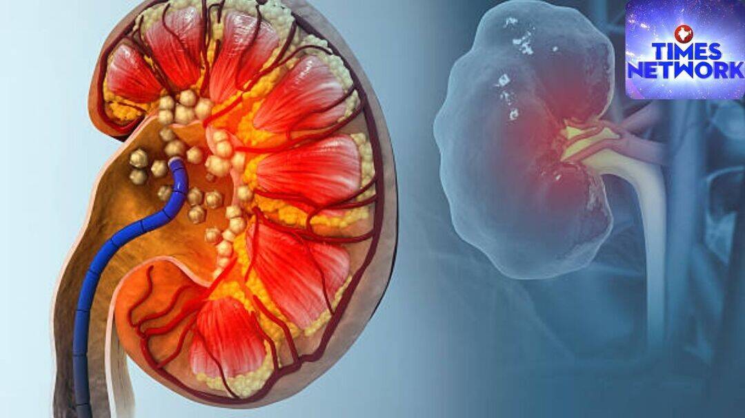 Why kidney stones spike in summer
