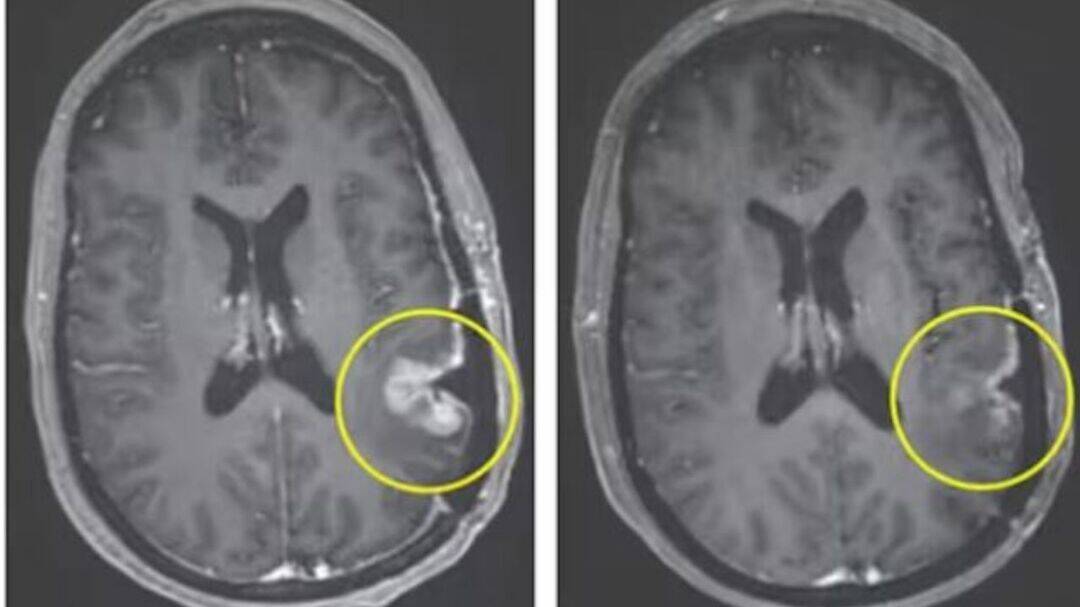 Cancer drug shrinks brain tumour in five days