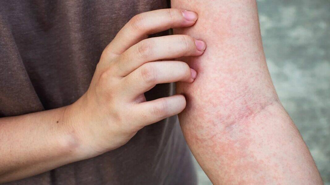 Is psoriasis contagious? 