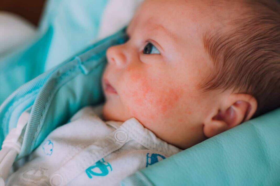 Why does some baby keep getting heat rash? 