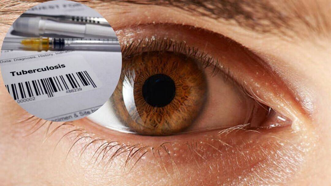 Eye TB inflammation can continue even after treatment: Study