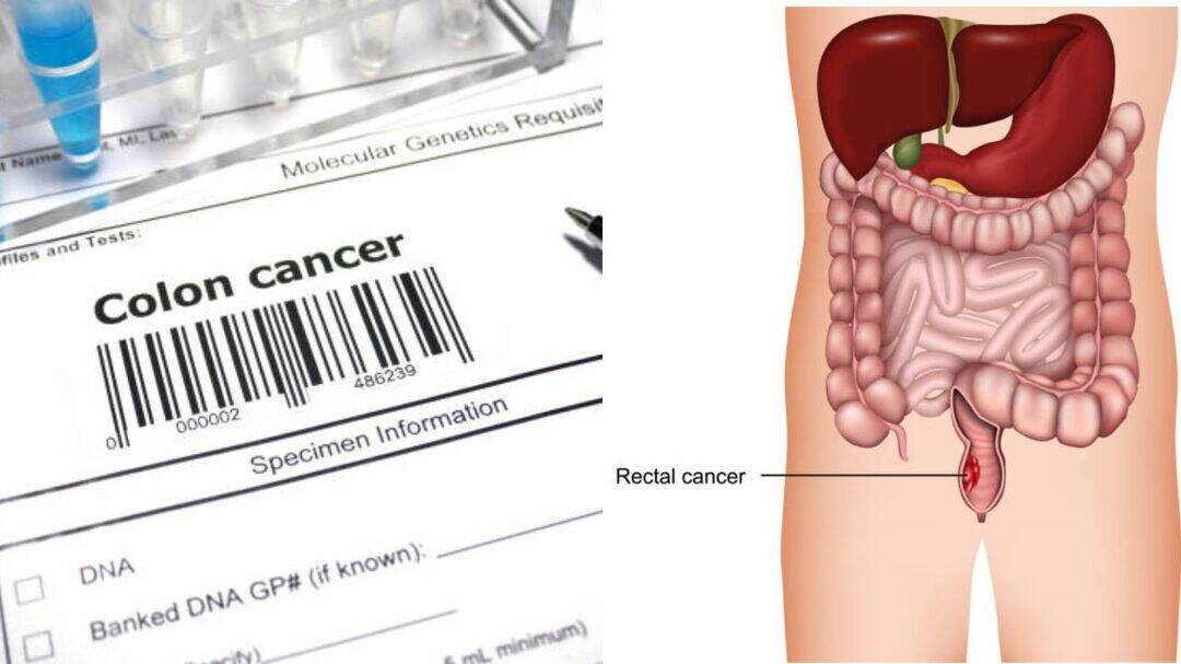 Rectal cancer rising among US millennials: Report