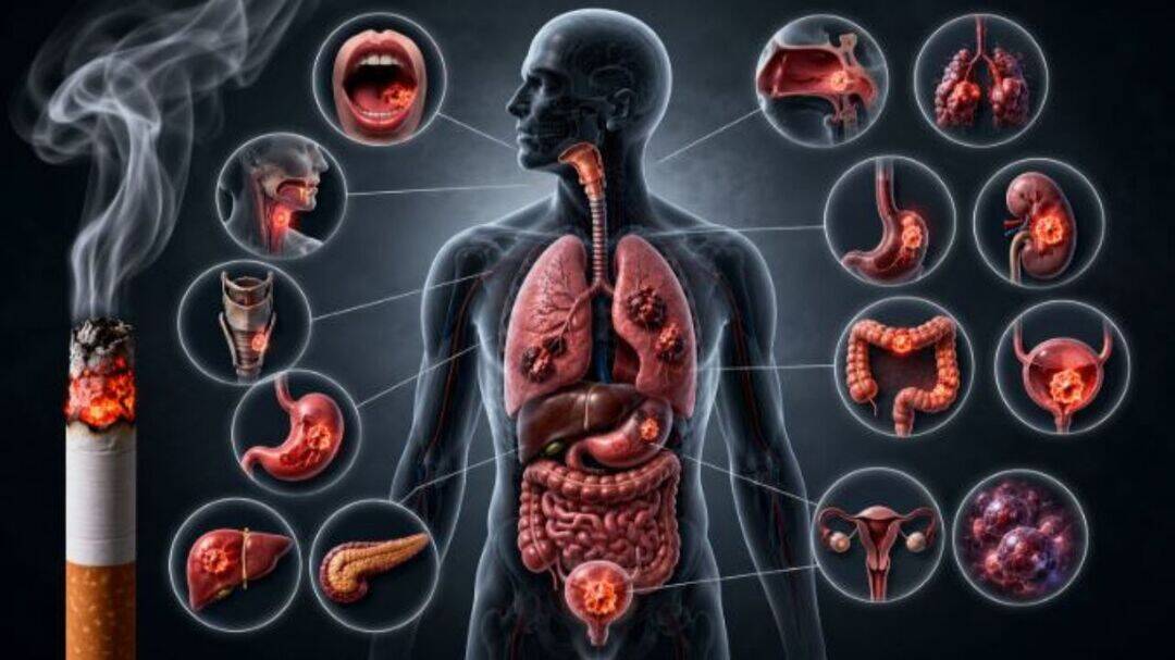 Smoking causes 15 types of cancer, not just lung cancer