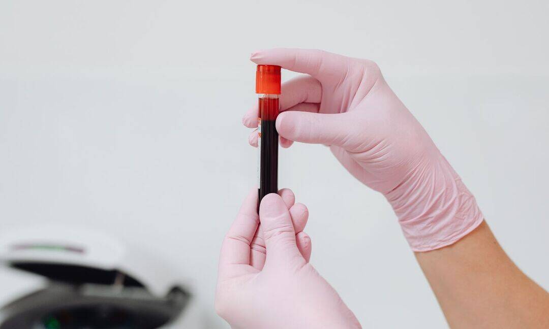 Anemia signs: fatigue and weakness should not be ignored