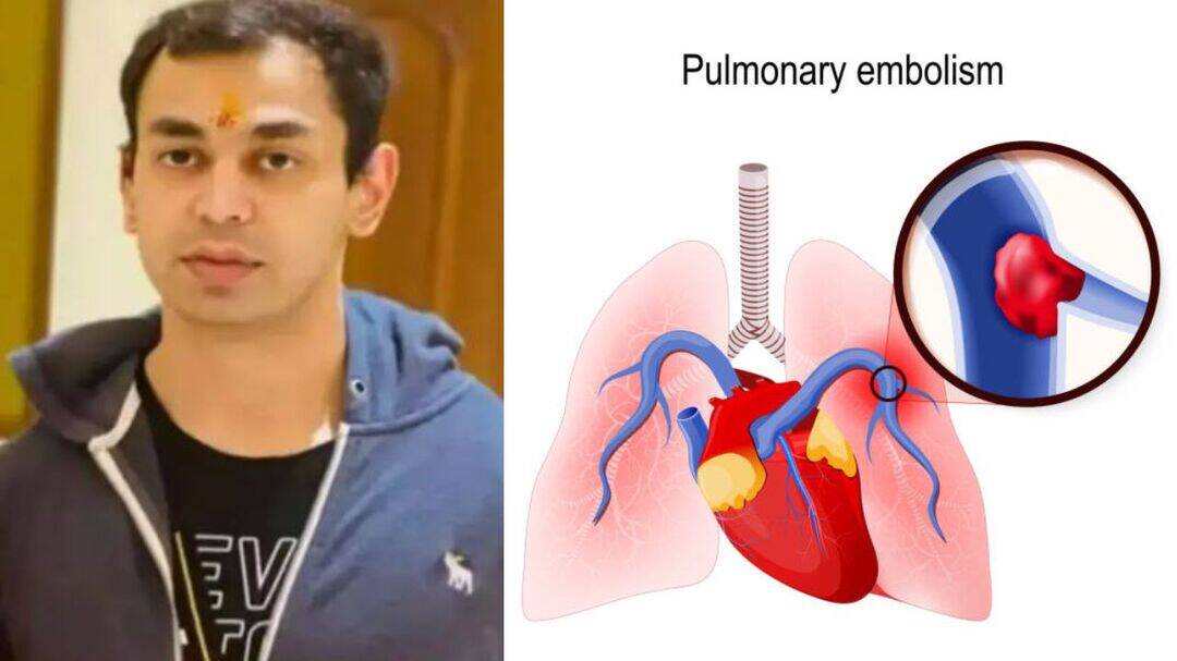 What is massive Pulmonary Thromboembolism?