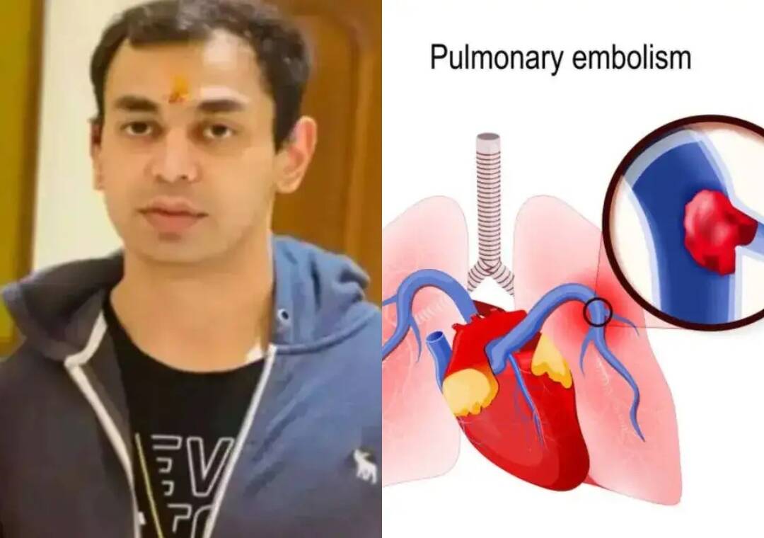 What is pulmonary thromboembolism that caused Prateek Yadav's death?