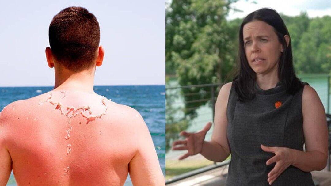 Excess sun exposure for 20 minutes may raise skin cancer risk
