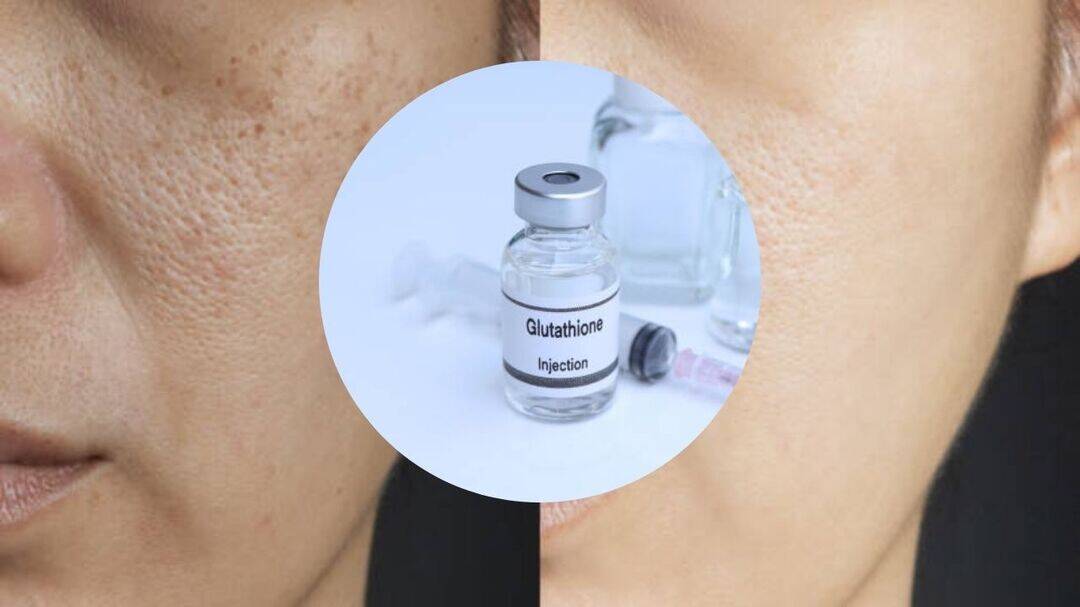 Beauty injection crackdown: Govt warns on glutathione drips