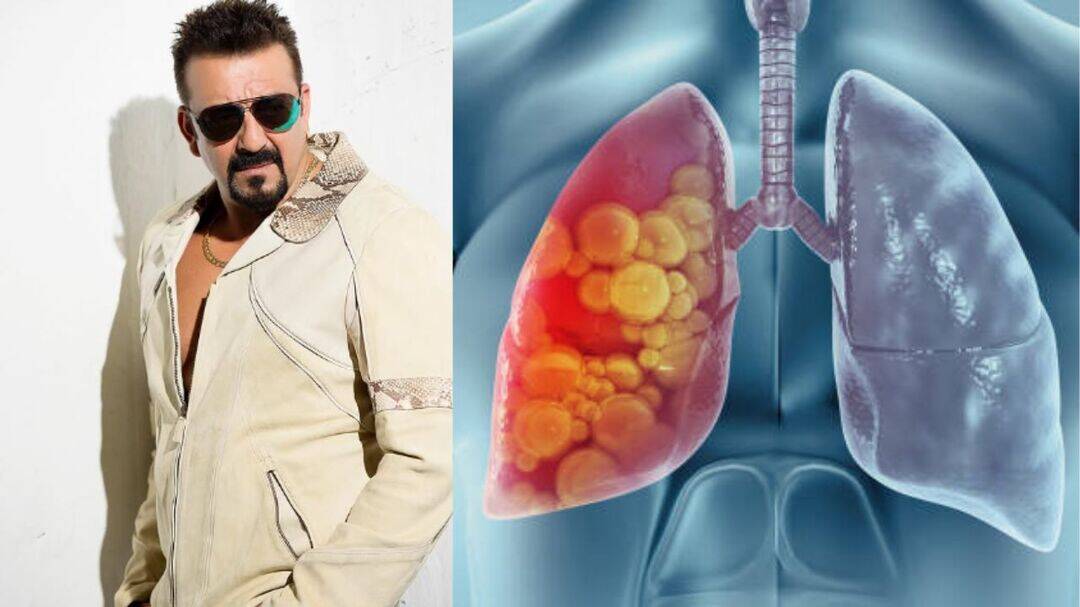 Sanjay Dutt’s LA check-up highlights cancer follow-ups