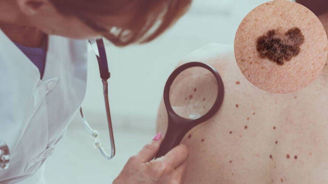 Melanoma cases hit record high in the UK