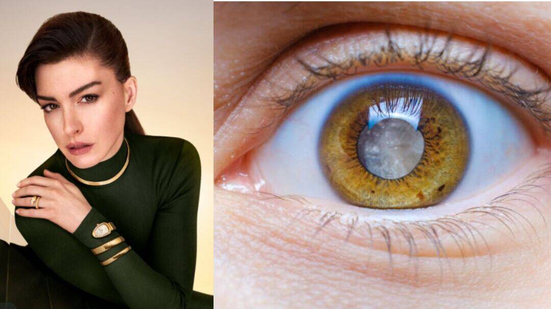 Anne Hathaway was 'legally blind’ in one eye for 10 years
