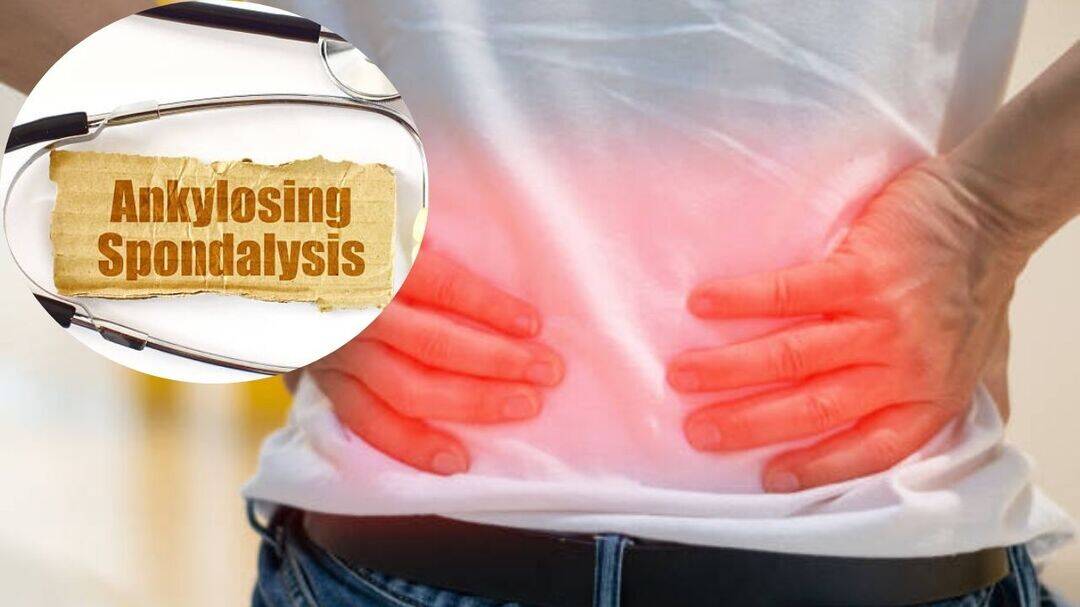 How can you stop Ankylosing Spondylitis from fusing the spine?