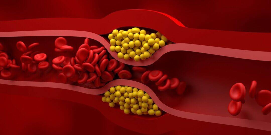 Eli Lilly tests therapy that can permanently cut bad cholesterol & stop heart attacks