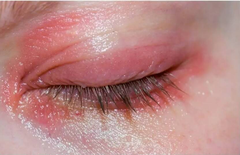 Understanding photokeratitis: Causes, symptoms and care