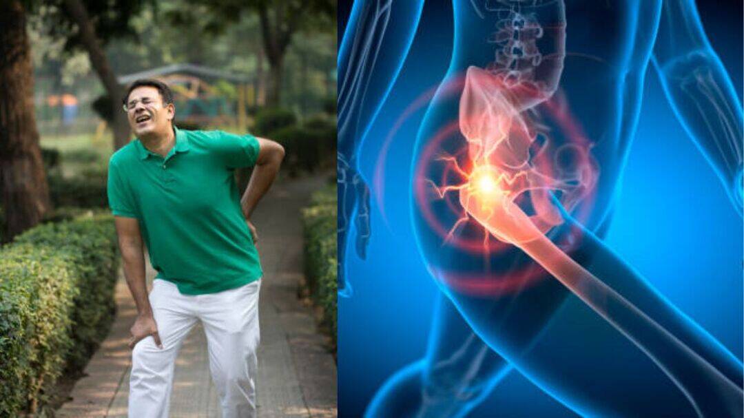 Doctors report hip damage in Indians in their 30s after COVID-19