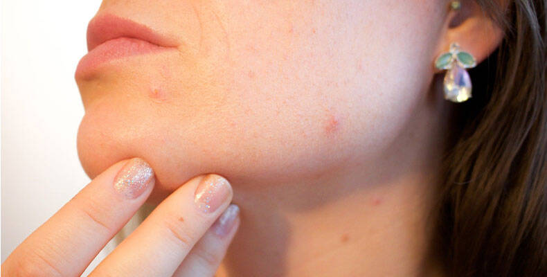 Pimples before menstruation result from hormonal changes in women