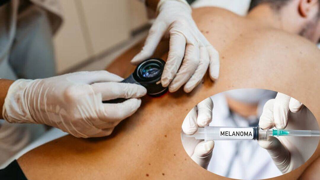 Personalised melanoma vaccine cuts recurrence risk five years