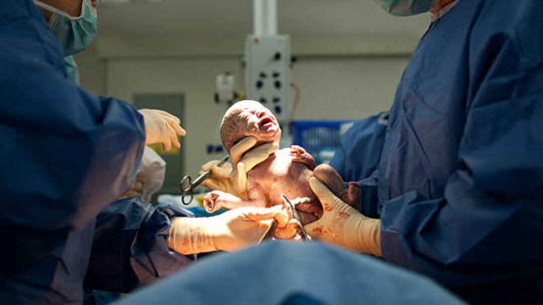 C-sections can be life-saving despite rising numbers: Experts