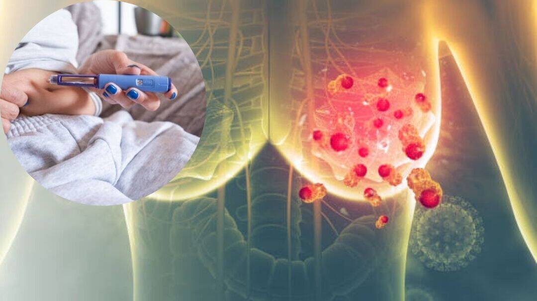 Ozempic-like drugs may help lower breast cancer risk, says study