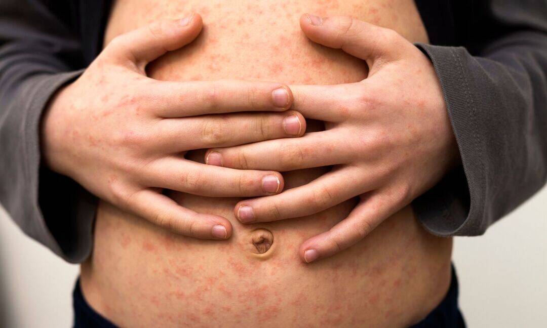 Bangladesh reports 8 more child deaths in measles outbreak