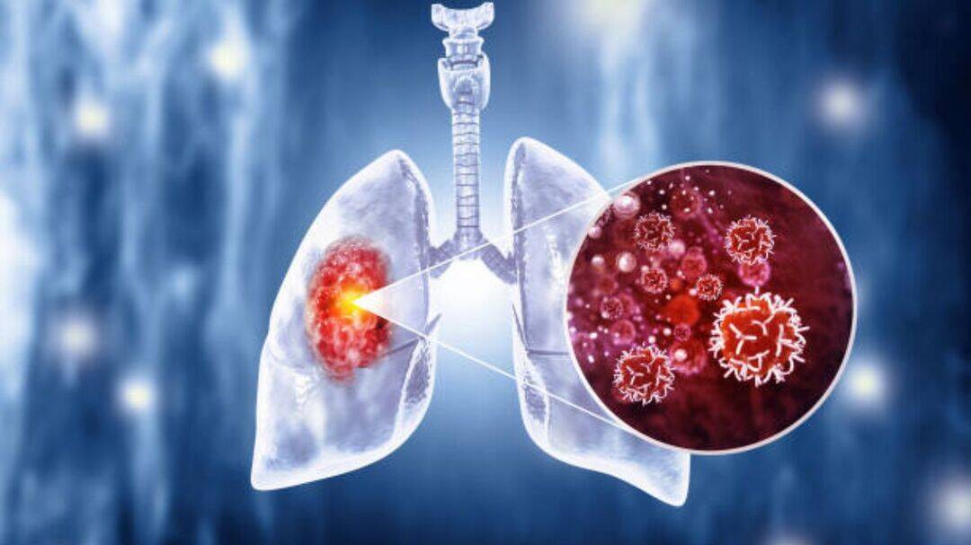 Blood test may predict lung cancer before it starts
